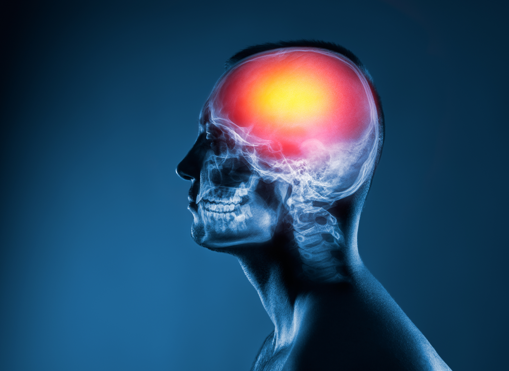 A profile x-ray of the upper half of a man's head. The bones of his skull can be seen. The area around his brain case glows red.